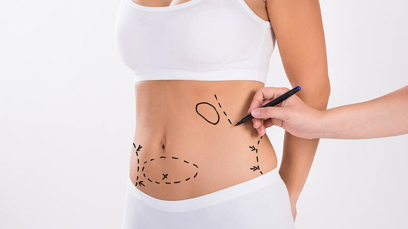 Is Liposuction Really Effective?