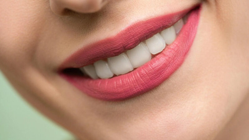 How Professional Teeth Whitening Works and Why Everyone Gets Different Results